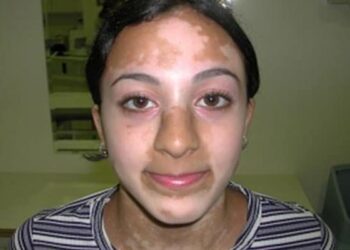 استاذ أمراض جلدية: مرض البهاق أصبح له علاج للتعافي نهائيا بشكل سريع