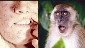 الصحة العالمية: استمرار تفشي جدرى القرود في أفريقيا وتحذير من خطر الانتقال المستدام بين الدول