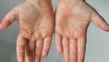 التعليم والصحة تطمئنان أولياء الأمور بعد ظهور أعراض جلدية على طلاب بمدرسة بالجيزة